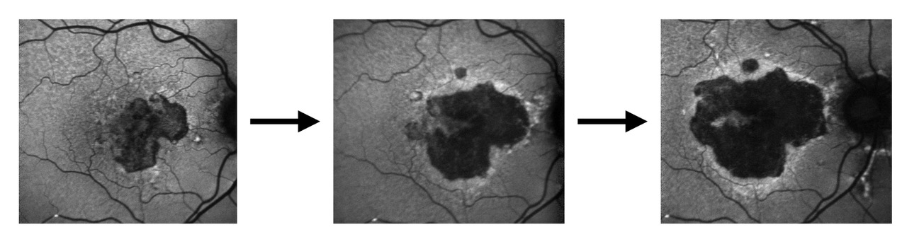 Geographic Atrophy (GA)