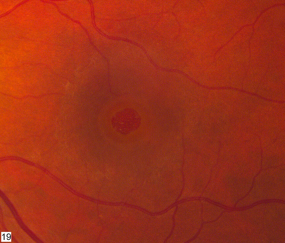 high-magnification-of-macular-hole