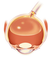 gas-bubble-face-down